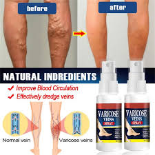 Veinhealing Varicose Veins Treatment Spray 60ml - Soothing Relief for Legs, Swelling & Fatigue