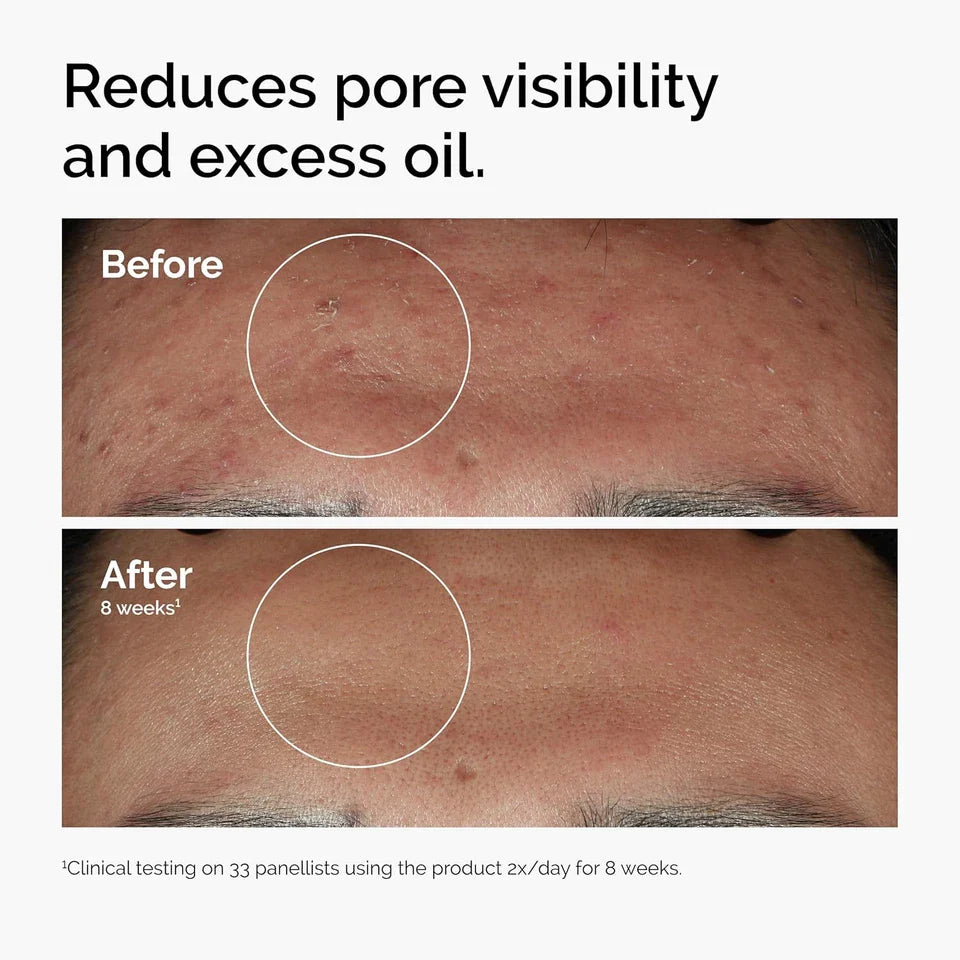 The Ordinary Niacinamide 10% + Zinc 1% Serum - Blemish-Prone Skin