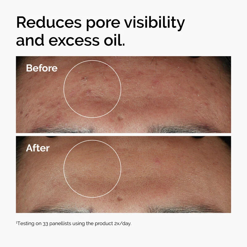 The Ordinary Niacinamide 10% + Zinc 1% – Oil Control & Blemish Serum